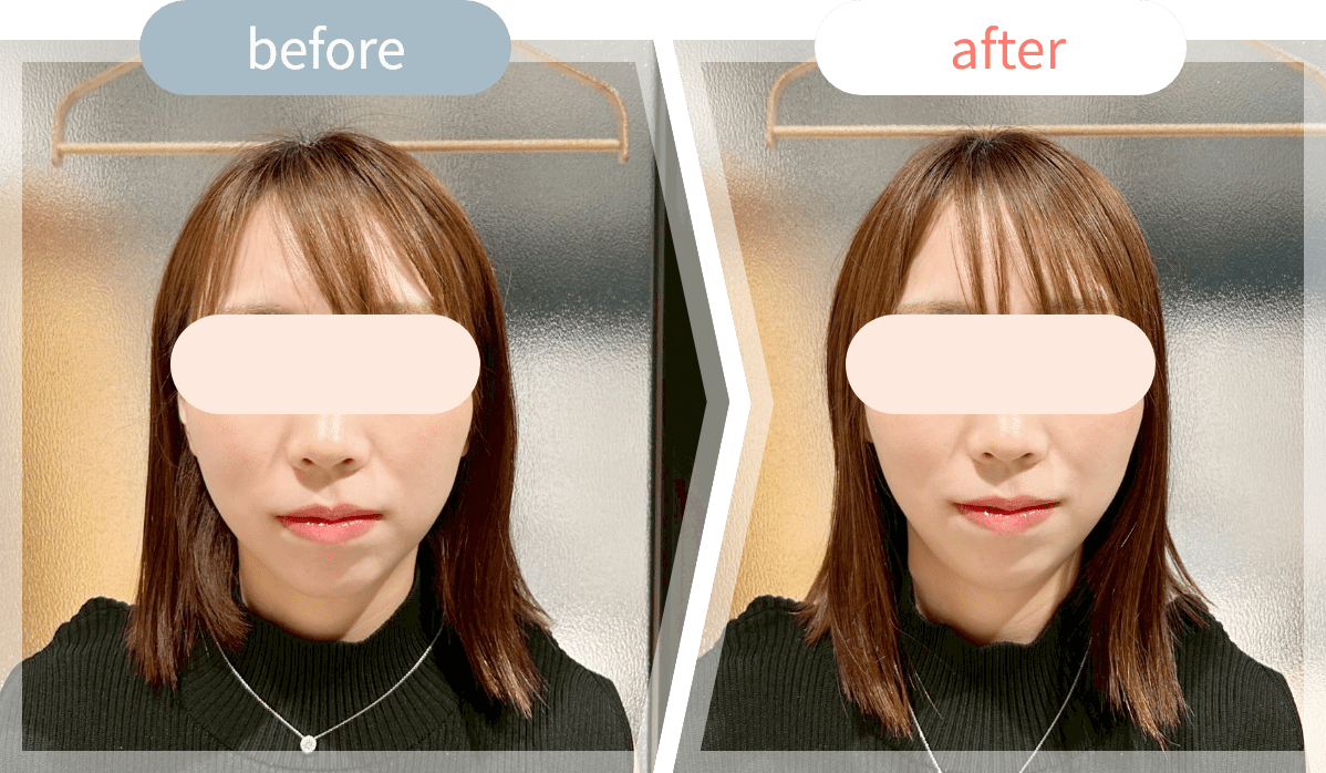 施術前後の顔写真